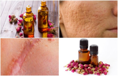 aceite de rosa mosqueta para las estrias
