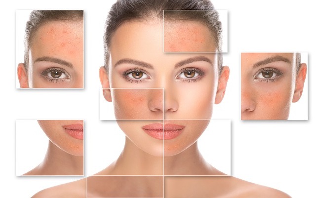 Batalla contra el acne