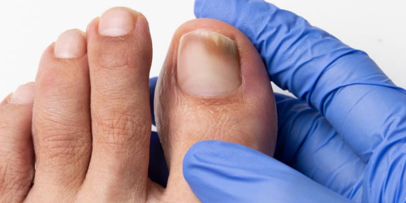 ¿Qué es la onicomicosis?