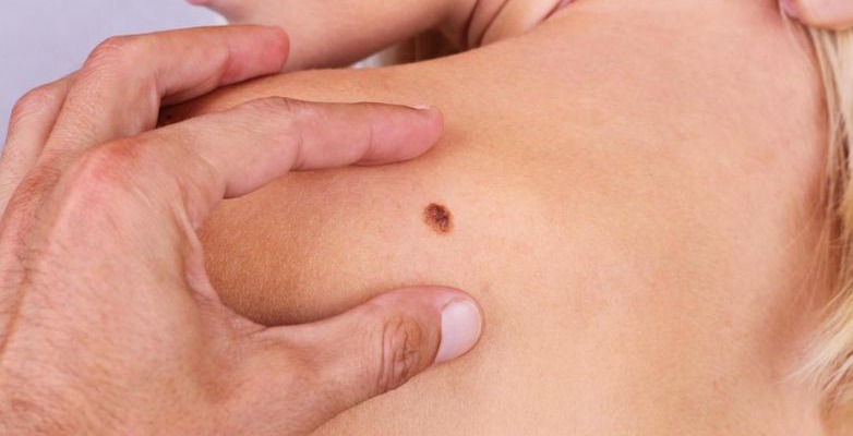 El melanoma: una guía para entenderlo y prevenirlo