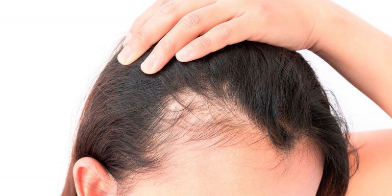 La caída del pelo es una situación que puede afectar a los hombres y las mujeres en cualquier momento de su vida. 