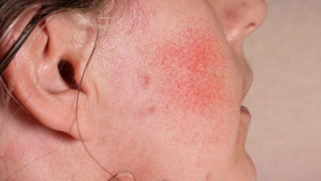 Consecuencias del exceso de sebo en las pieles grasas: arrugas, imperfecciones, rosácea. Perfecciona tu piel.