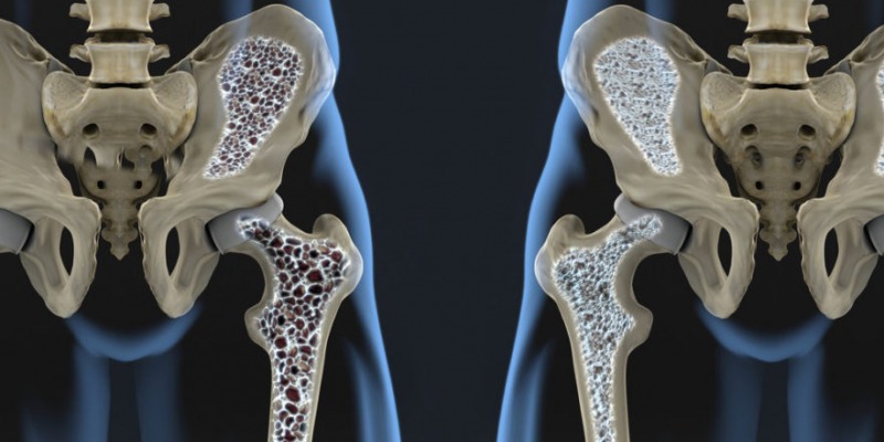Osteoporosis. 