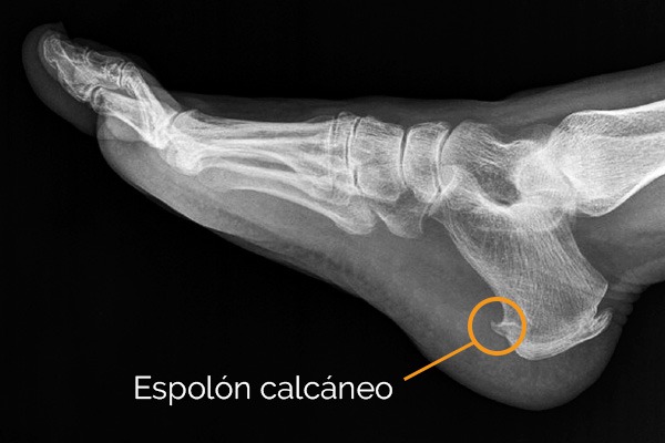 Espolón Calcáneo: Causas, Síntomas y cómo curarlo