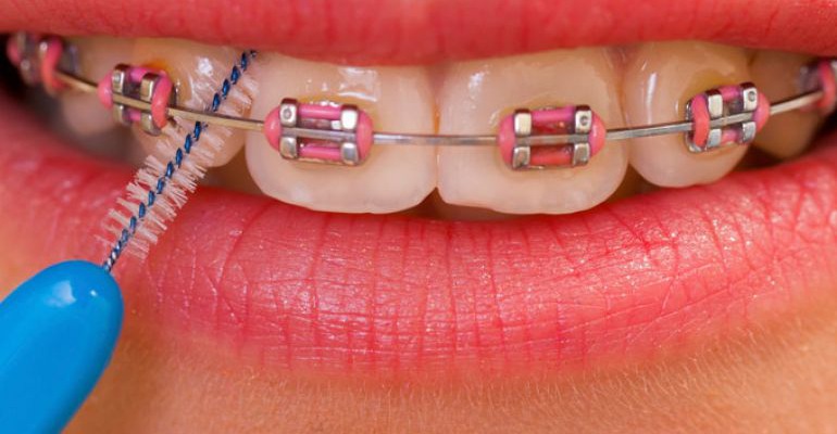 La importancia de una buena higiene bucal con brackets, 10 errores comunes a evitar.