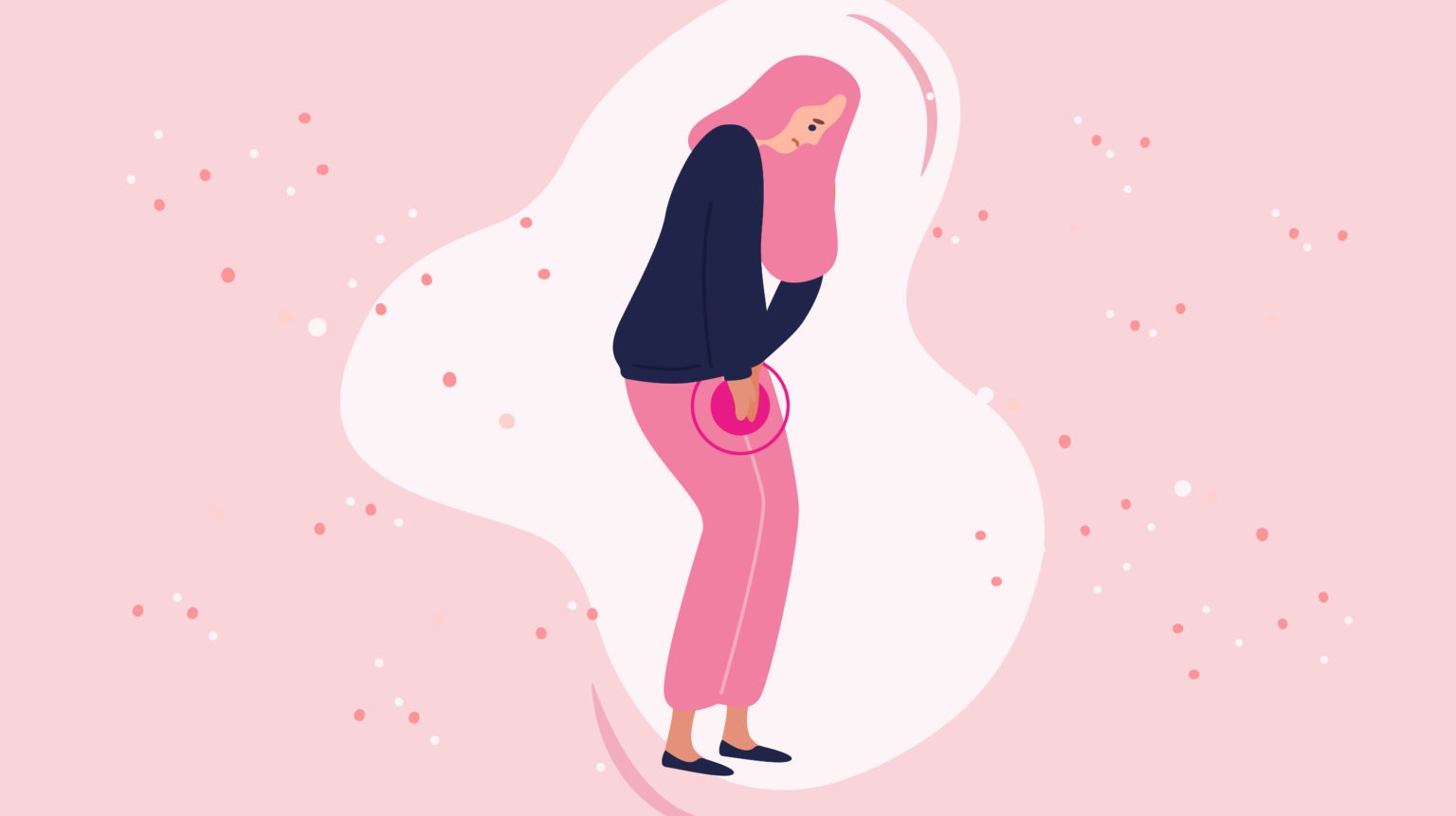 Salud femenina: Síndrome de Mittelshmerz o dolor intermentrual.