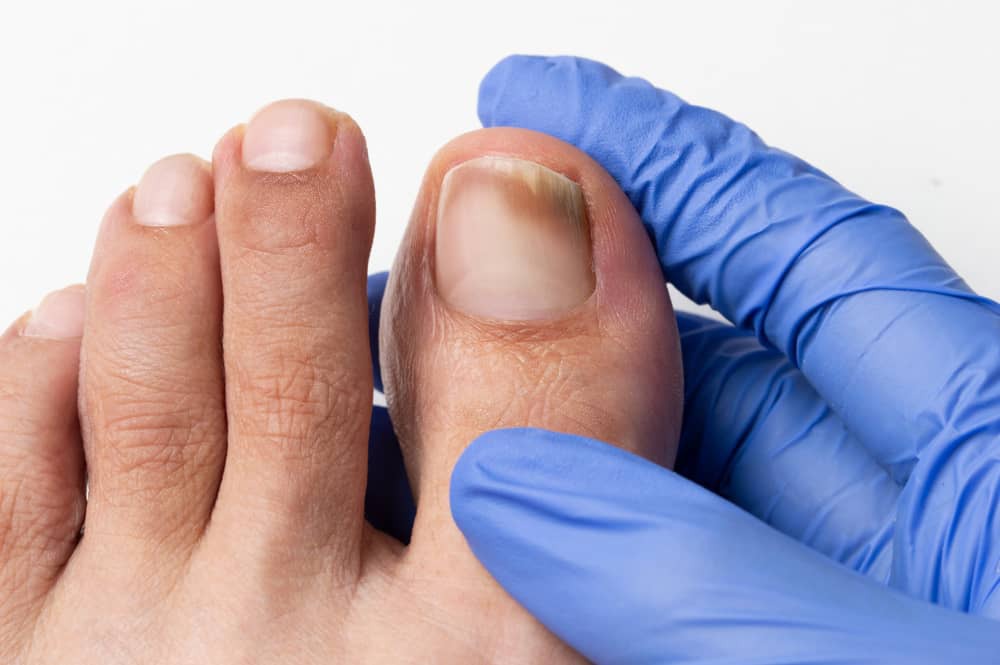¿Qué es la onicomicosis?