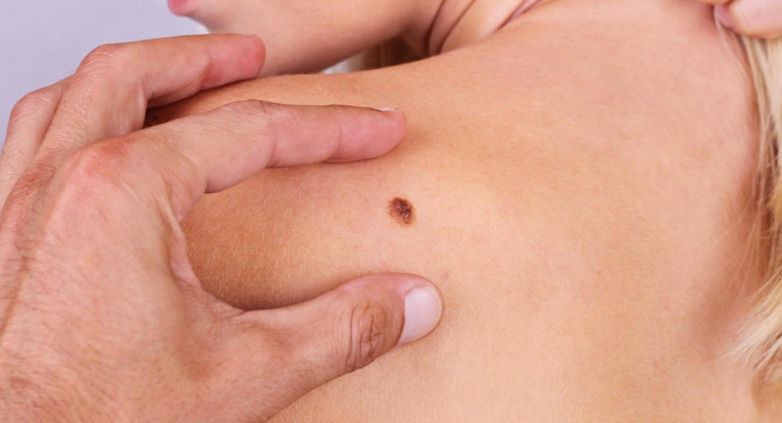 El melanoma: una guía para entenderlo y prevenirlo