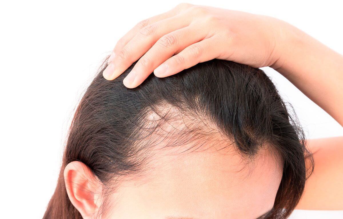 La caída del pelo es una situación que puede afectar a los hombres y las mujeres en cualquier momento de su vida. 