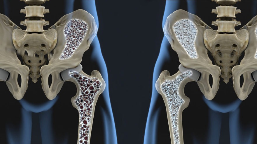 Osteoporosis. 